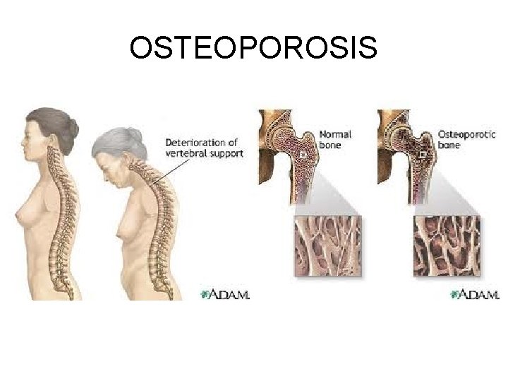 OSTEOPOROSIS OSTEOPOROSIS