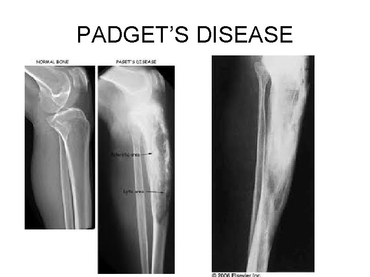 PADGET’S DISEASE PADGET’S DISEASE