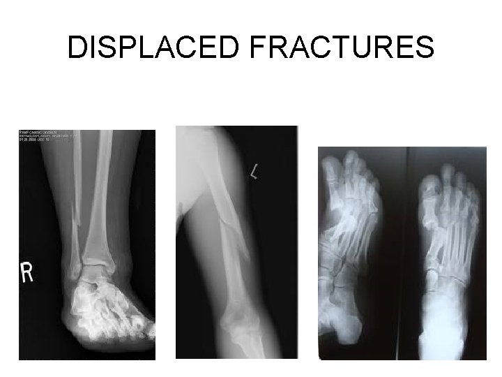 DISPLACED FRACTURES DISPLACED FRACTURES
