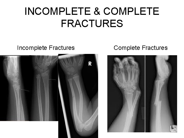 INCOMPLETE & COMPLETE FRACTURES Incomplete Fractures Complete Fractures INCOMPLETE & COMPLETE FRACTURES Incomplete Fractures Complete Fractures