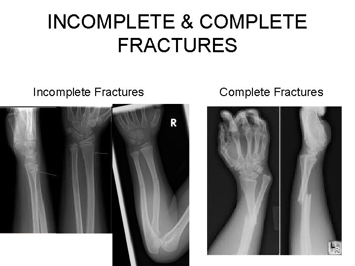 INCOMPLETE & COMPLETE FRACTURES Incomplete Fractures Complete Fractures 