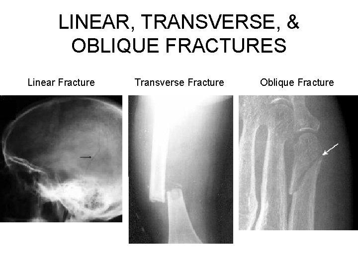 LINEAR, TRANSVERSE, & OBLIQUE FRACTURES Linear Fracture Transverse Fracture Oblique Fracture 