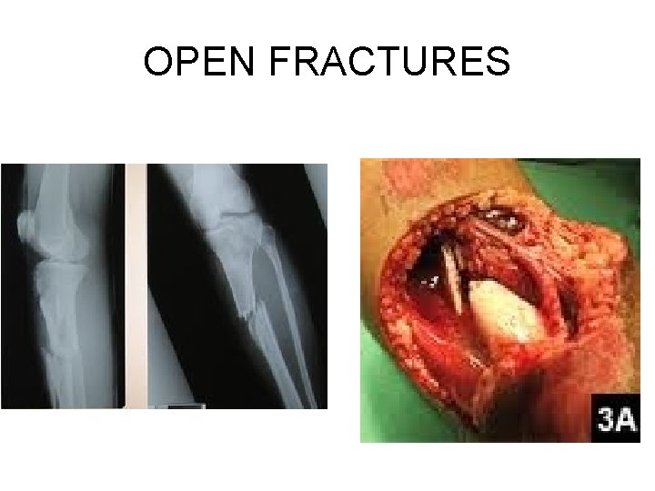 OPEN FRACTURES OPEN FRACTURES