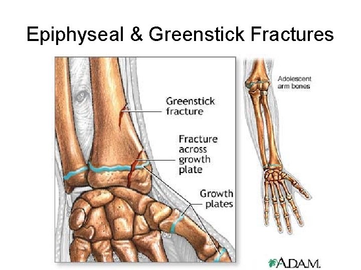 Epiphyseal & Greenstick Fractures Epiphyseal & Greenstick Fractures