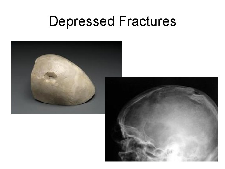 Depressed Fractures 