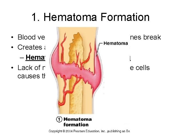 1. Hematoma Formation • Blood vessels are ruptured when bones break • Creates a