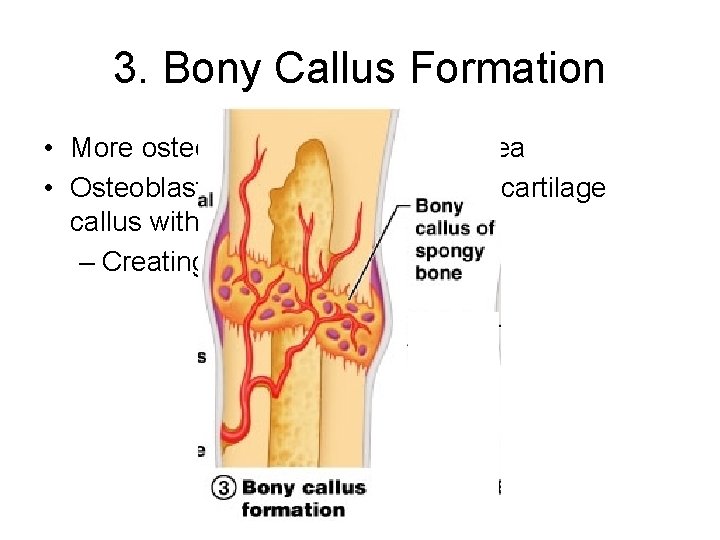 3. Bony Callus Formation • More osteoblasts migrate to the area • Osteoblasts gradually