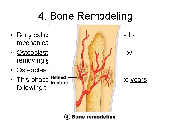 4. Bone Remodeling • Bony callus is remodeled in response to mechanical stresses put