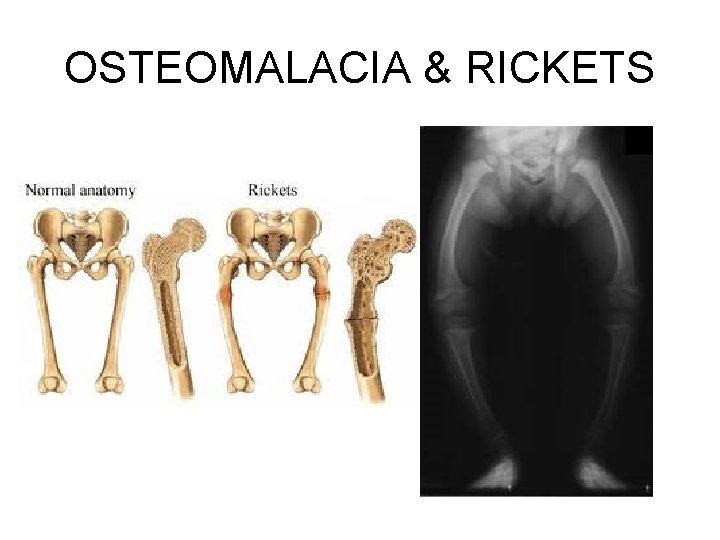 OSTEOMALACIA & RICKETS 