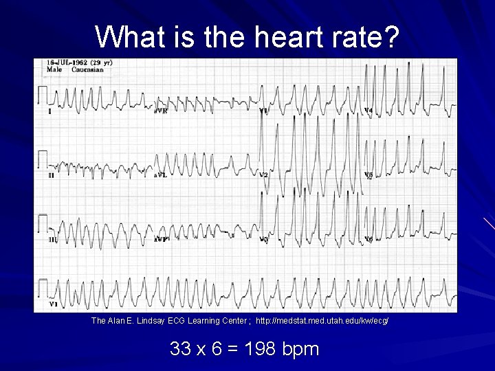 What is the heart rate? The Alan E. Lindsay ECG Learning Center ; http: