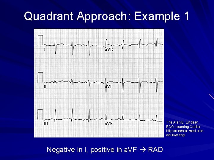 Quadrant Approach: Example 1 The Alan E. Lindsay ECG Learning Center http: //medstat. med.