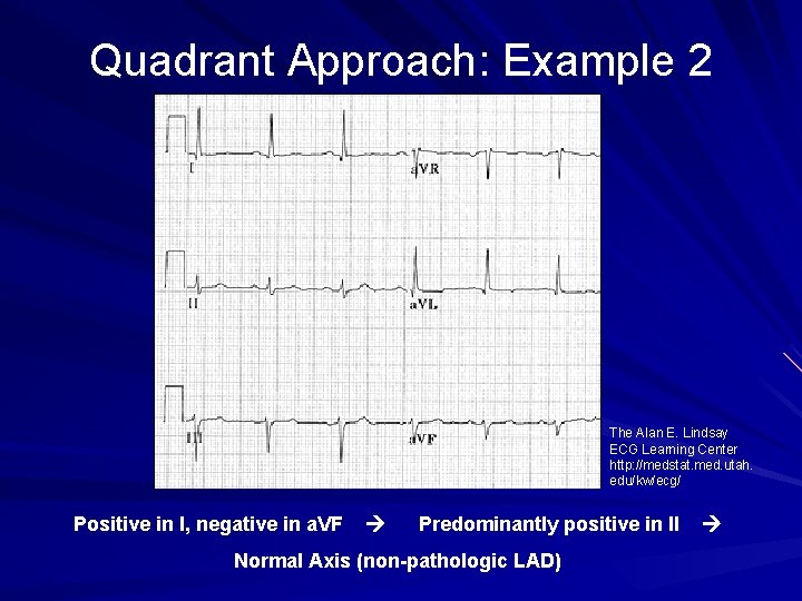 Quadrant Approach: Example 2 The Alan E. Lindsay ECG Learning Center http: //medstat. med.
