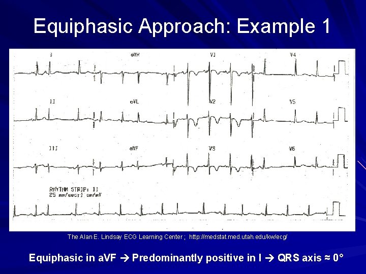 Equiphasic Approach: Example 1 The Alan E. Lindsay ECG Learning Center ; http: //medstat.