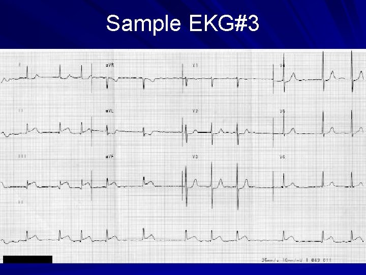 Sample EKG#3 