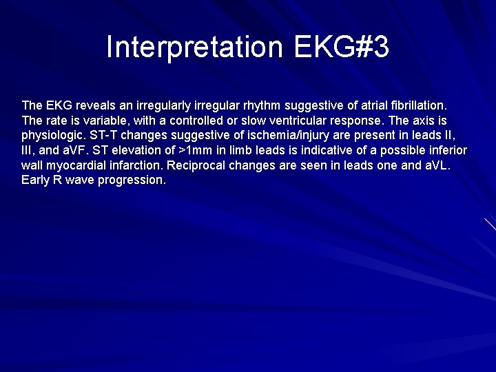 Interpretation EKG#3 The EKG reveals an irregularly irregular rhythm suggestive of atrial fibrillation. The
