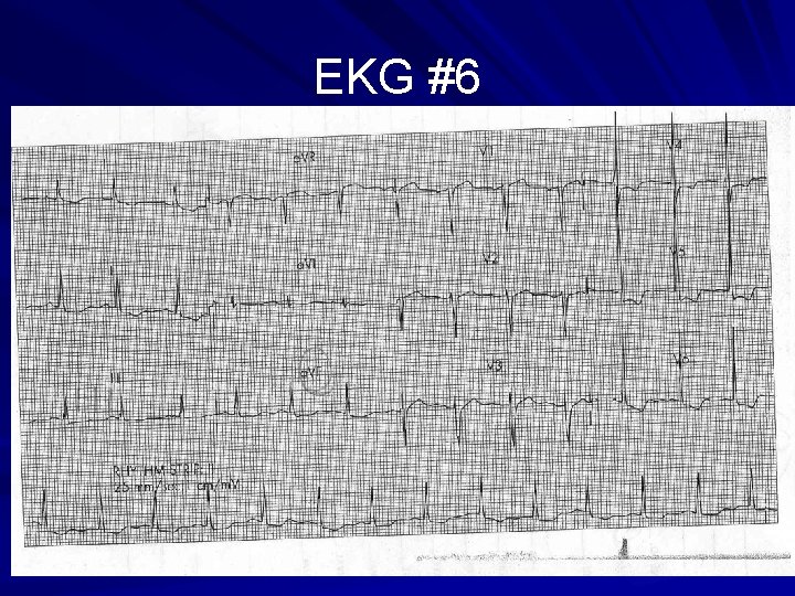 EKG #6 