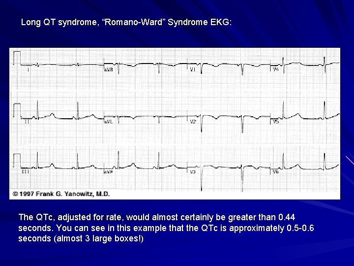 Long QT syndrome, “Romano-Ward” Syndrome EKG: The QTc, adjusted for rate, would almost certainly