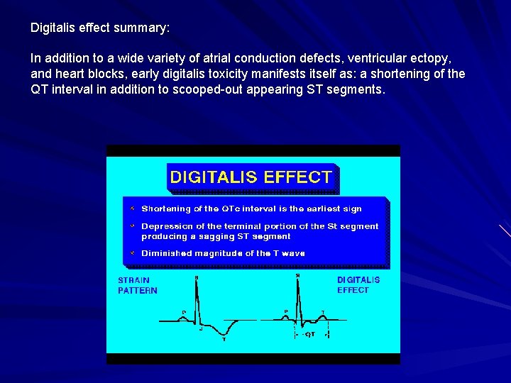 Digitalis effect summary: In addition to a wide variety of atrial conduction defects, ventricular