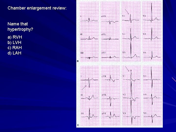 Chamber enlargement review: Name that hypertrophy? a) RVH b) LVH c) RAH d) LAH