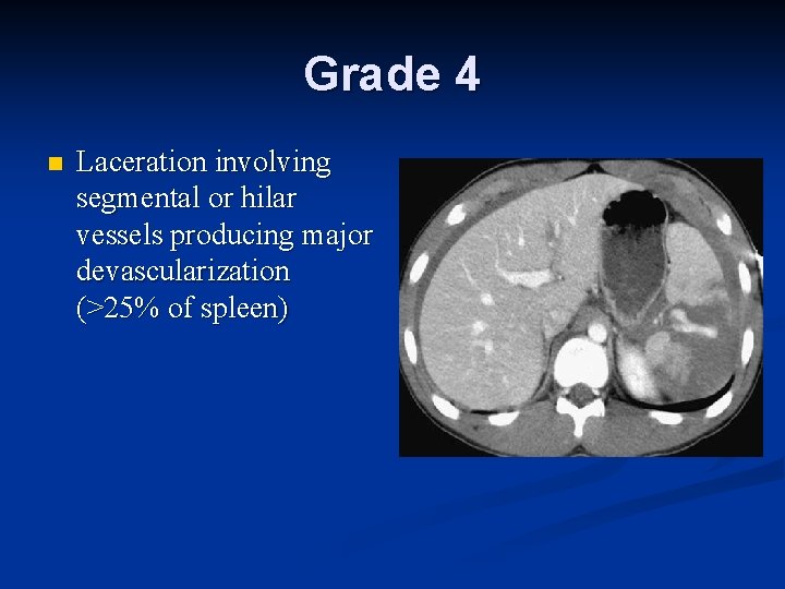 Grade 4 n Laceration involving segmental or hilar vessels producing major devascularization (>25% of