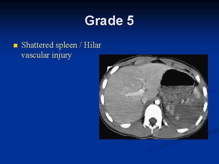 Grade 5 n Shattered spleen / Hilar vascular injury 