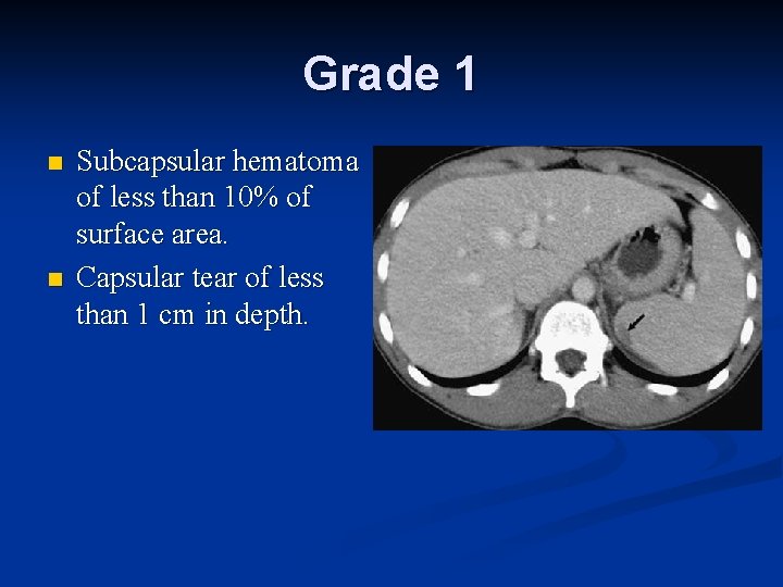 Grade 1 n n Subcapsular hematoma of less than 10% of surface area. Capsular