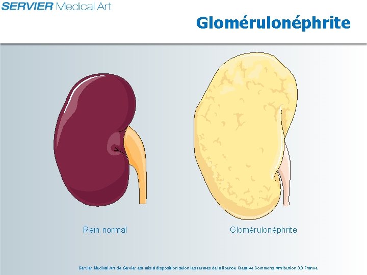 Glomérulonéphrite Rein normal Glomérulonéphrite Servier Medical Art de Servier est mis à disposition selon