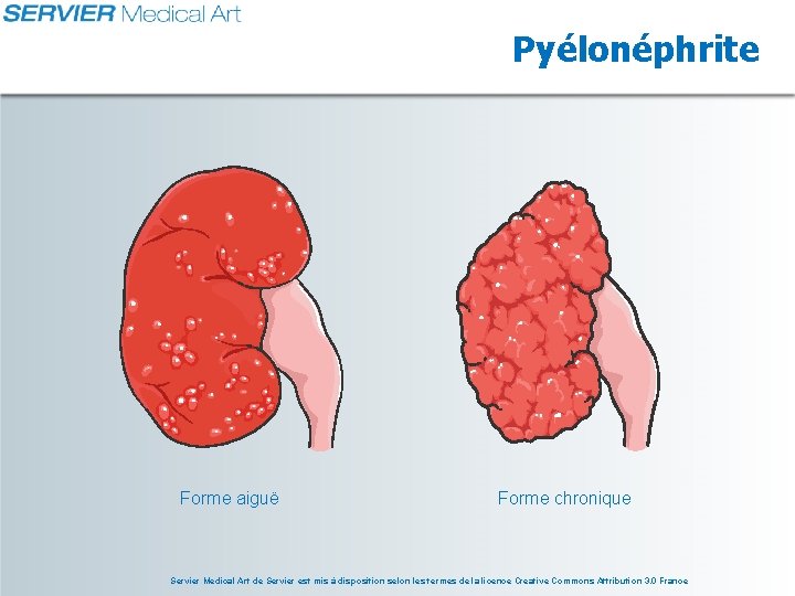 Pyélonéphrite Forme aiguë Forme chronique Servier Medical Art de Servier est mis à disposition