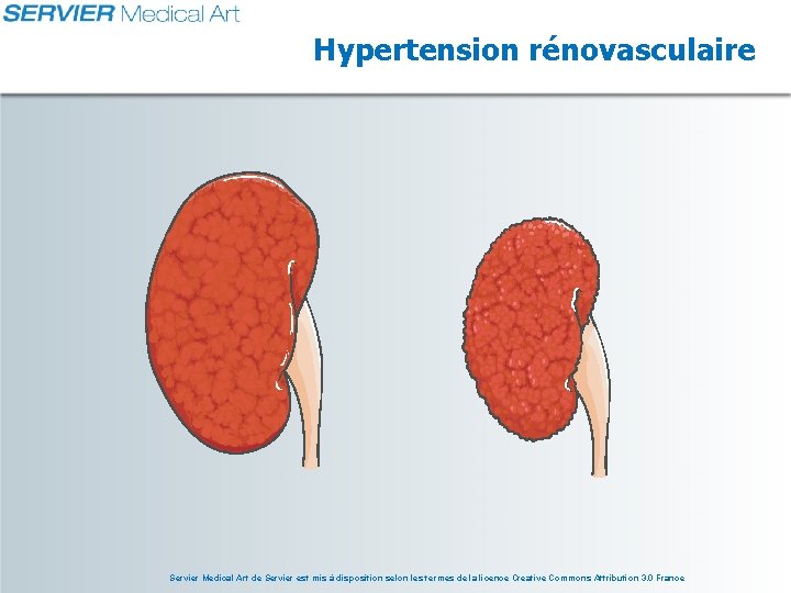 Hypertension rénovasculaire Servier Medical Art de Servier est mis à disposition selon les termes