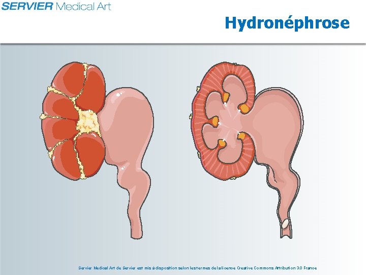 Hydronéphrose Servier Medical Art de Servier est mis à disposition selon les termes de