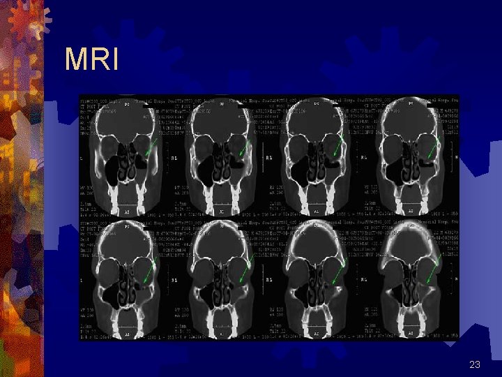 MRI 23 