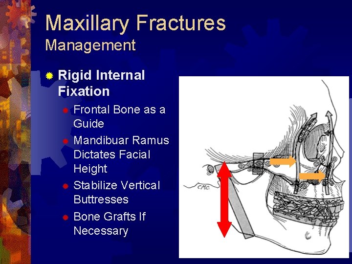 Maxillary Fractures Management ® Rigid Internal Fixation Frontal Bone as a Guide ® Mandibuar