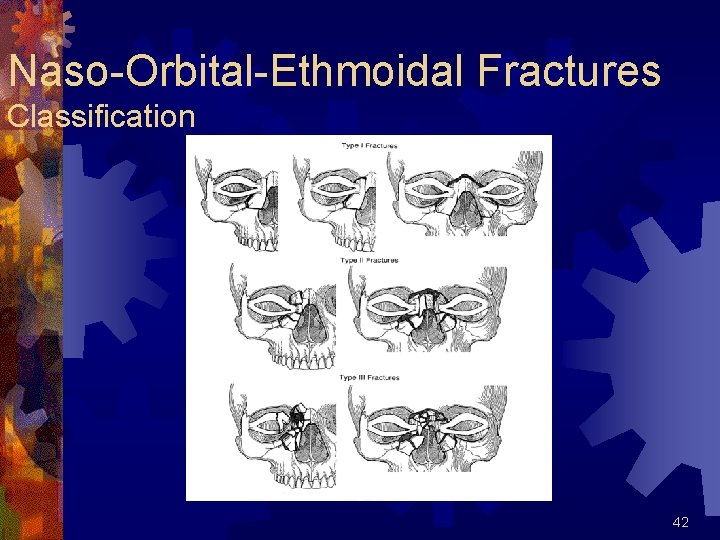 Naso-Orbital-Ethmoidal Fractures Classification 42 