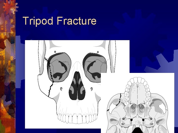 Tripod Fracture 48 