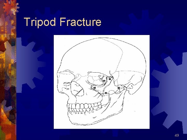 Tripod Fracture 49 