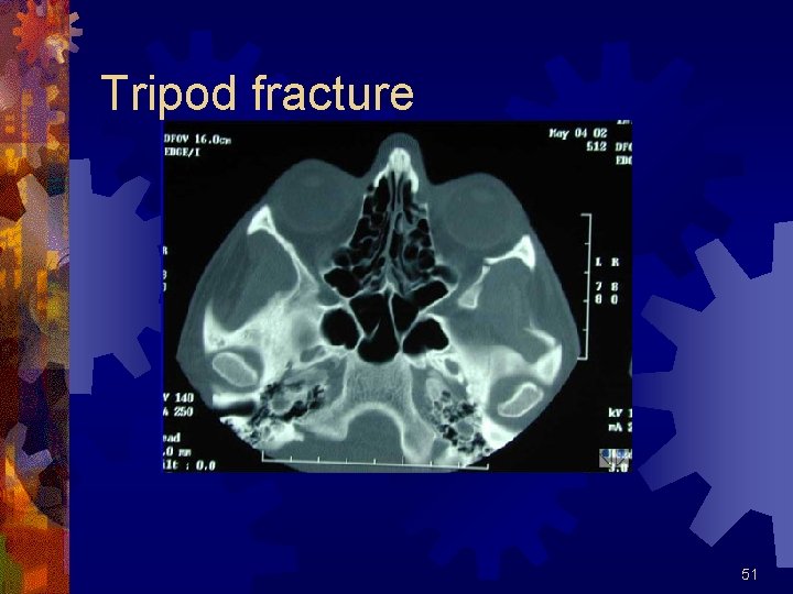 Tripod fracture 51 