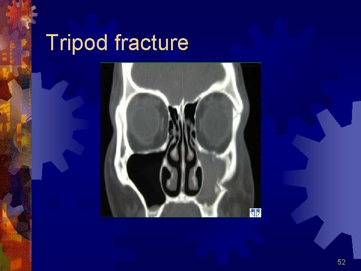 Tripod fracture 52 