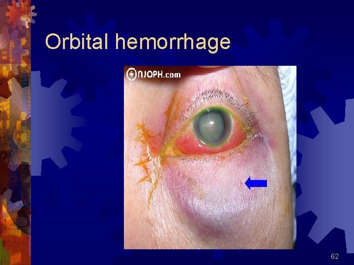 Orbital hemorrhage 62 