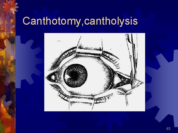 Canthotomy, cantholysis 63 