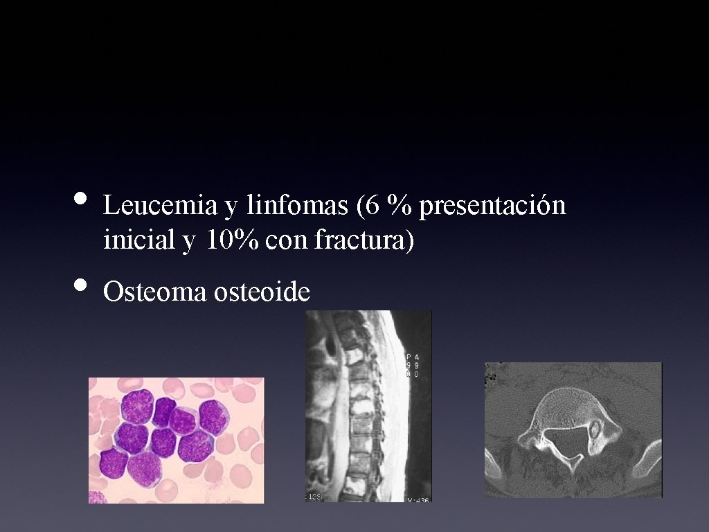  • Leucemia y linfomas (6 % presentación inicial y 10% con fractura) •