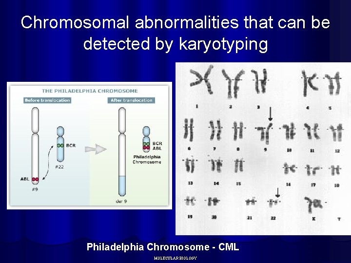 Chromosomal abnormalities that can be detected by karyotyping Philadelphia Chromosome - CML MOLECULAR BIOLOGY