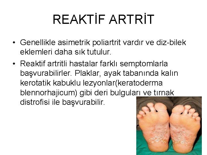 REAKTİF ARTRİT • Genellikle asimetrik poliartrit vardır ve diz-bilek eklemleri daha sık tutulur. •