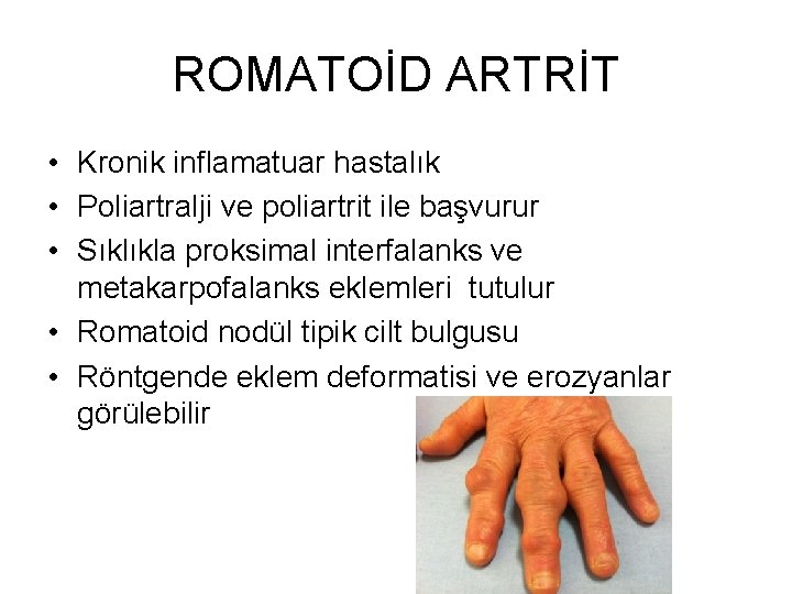 ROMATOİD ARTRİT • Kronik inflamatuar hastalık • Poliartralji ve poliartrit ile başvurur • Sıklıkla