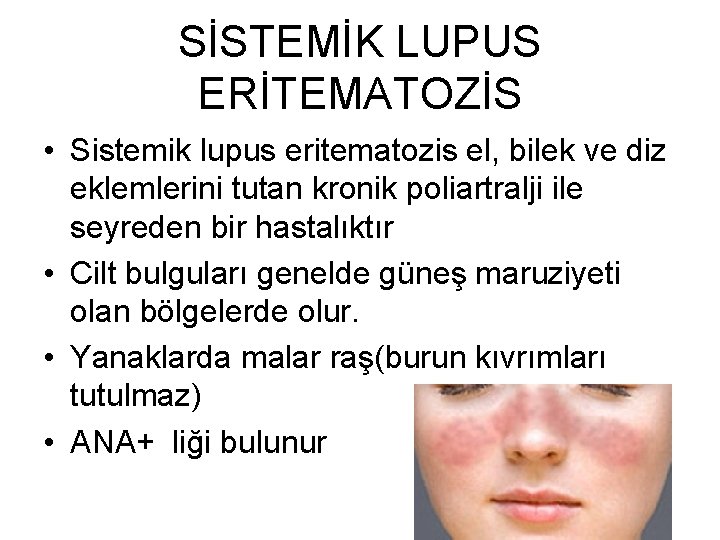 SİSTEMİK LUPUS ERİTEMATOZİS • Sistemik lupus eritematozis el, bilek ve diz eklemlerini tutan kronik