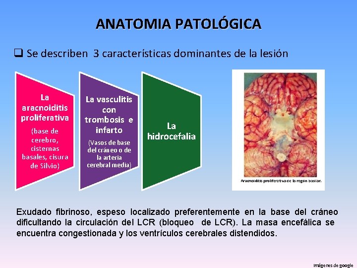 ANATOMIA PATOLÓGICA q Se describen 3 características dominantes de la lesión La aracnoiditis proliferativa
