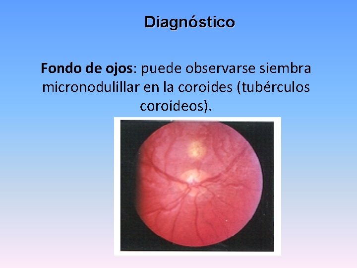 Diagnóstico Fondo de ojos: puede observarse siembra micronodulillar en la coroides (tubérculos coroideos). 