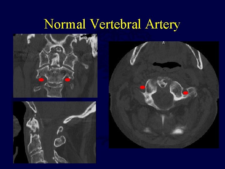 Normal Vertebral Artery 