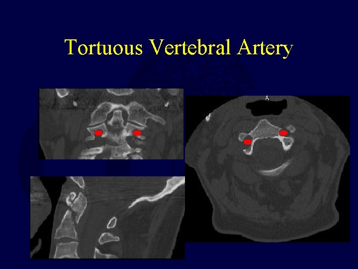 Tortuous Vertebral Artery 