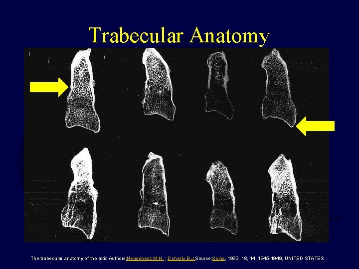 Trabecular Anatomy The trabecular anatomy of the axis Authors: Heggeness, M. H. ; Doherty,