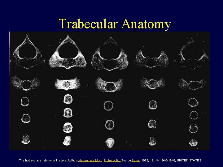 Trabecular Anatomy The trabecular anatomy of the axis Authors: Heggeness, M. H. ; Doherty,